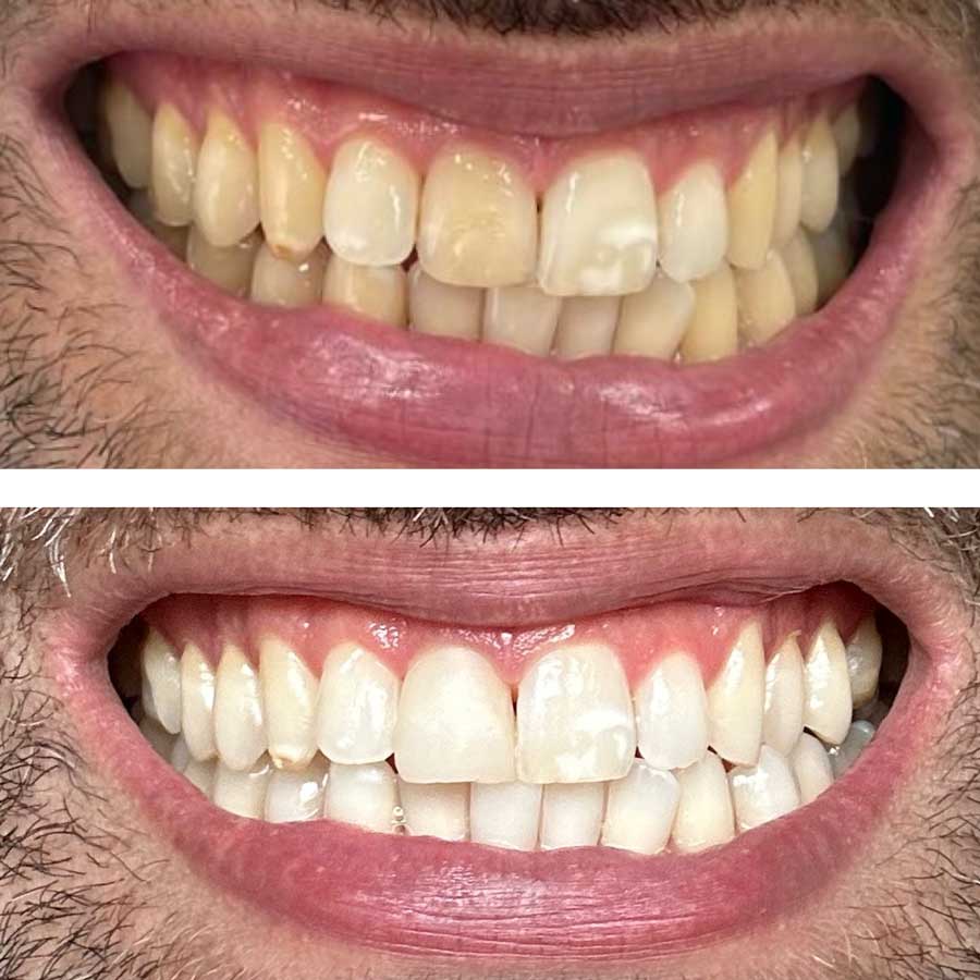 Tanden gezond bleken